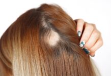Restoring Confidence: Hair Reshaping for Deeper Areas of Alopecia Alopecia