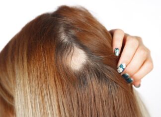 Restoring Confidence: Hair Reshaping for Deeper Areas of Alopecia Alopecia