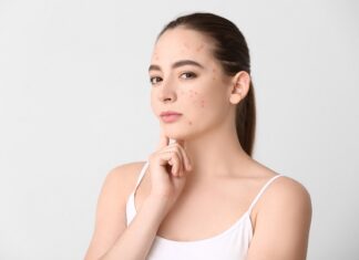 Blue Light and Acne: A Close Look at Its Effectiveness Acne